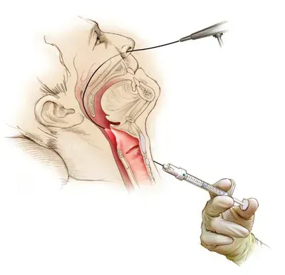 Voice Surgery for Vocal Cord Tumors service image