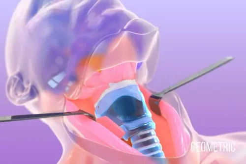 Voice Surgery for Vocal Cord Palsy service image