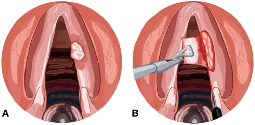 Microlaryngeal Surgery for Vocal Cord Swelling service image