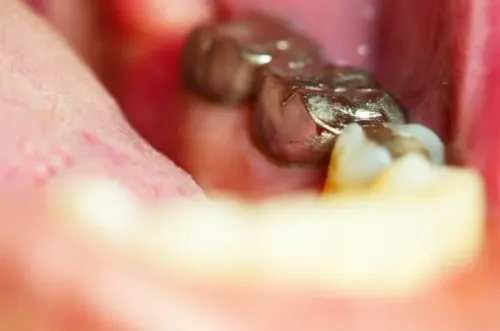 Fillings and Sealants service image