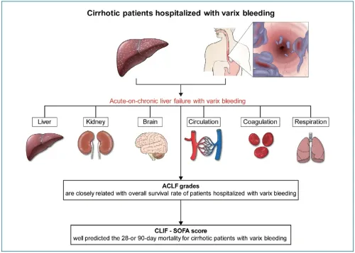 ACLF:- Acute chronic liver failure service image