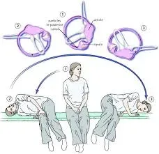 Canalith Repositioning (CR) service image