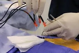 Radiofrequency Neurotomy Procedure service image