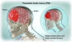 Traumatic Brain Injury (Tbi) Treatment service image