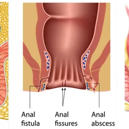 Fissure & Fistula Surgery service image