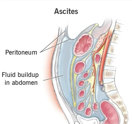 Ascites service image