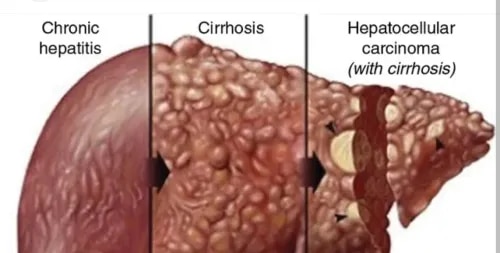 Hepatocellular Carcinoma Or HCC service image