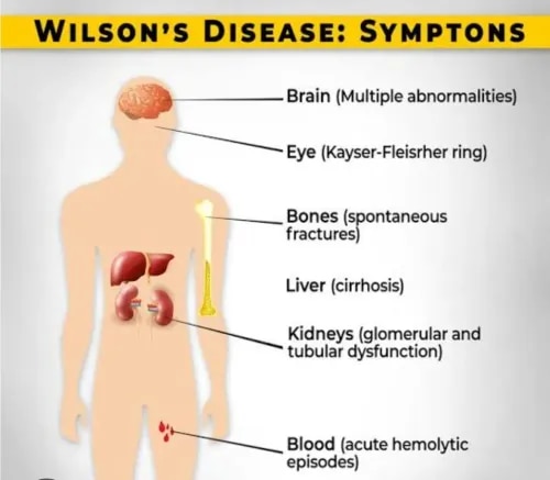 Wilson Disease  service image