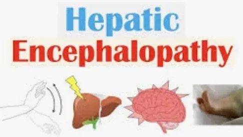 Hepatic Encephalopathy Treatment | Early Diagnosis & Management in Mumbai and India service image