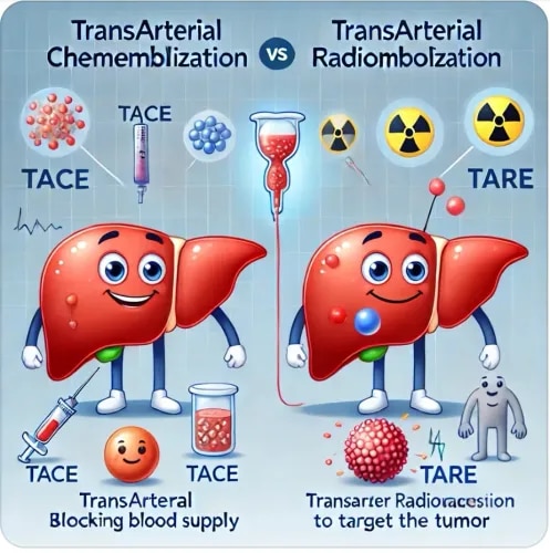 (Advanced Non-Surgical Treatment for Liver Tumors – TACE & TARE) service image
