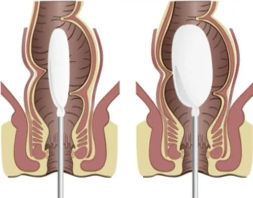 Anorectal Manometry service image