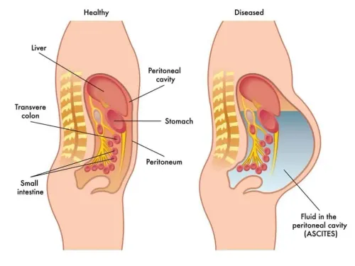 Ascites Treatment | Effective Fluid Management for Liver Disease in Mumbai India service image