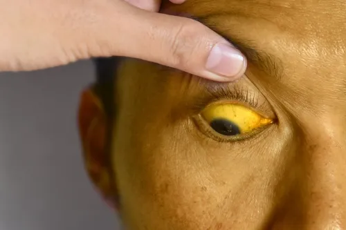 Jaundice Treatment | Expert Diagnosis & Liver Care in Mumbai service image
