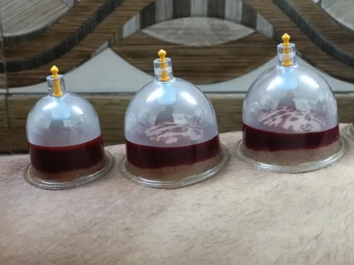 CUPPING THERAPY  service image
