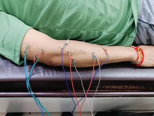 Electro Acupuncture  service image