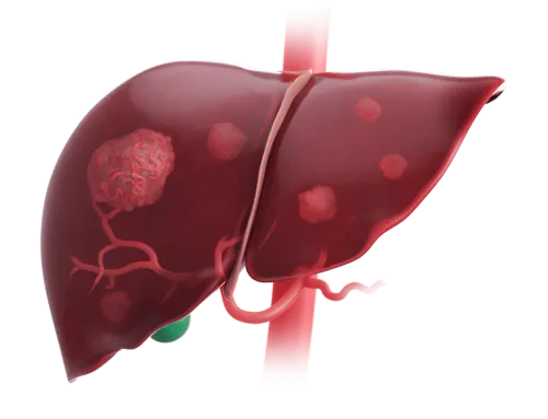  Liver Cancer (Hepatocellular Carcinoma) Diagnosis & Treatment service image