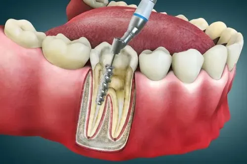 ROOT CANAL  service image