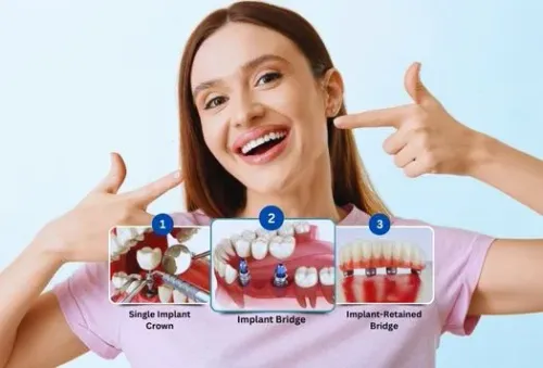 DENTAL IMPLANTS  service image