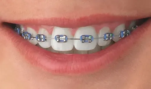 BRACES service image