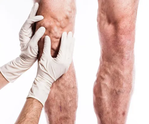 Varicose Veins Treatment service image
