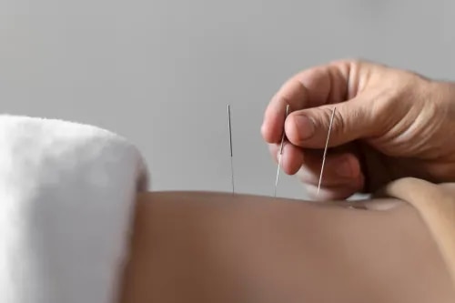 Dry Needling service image