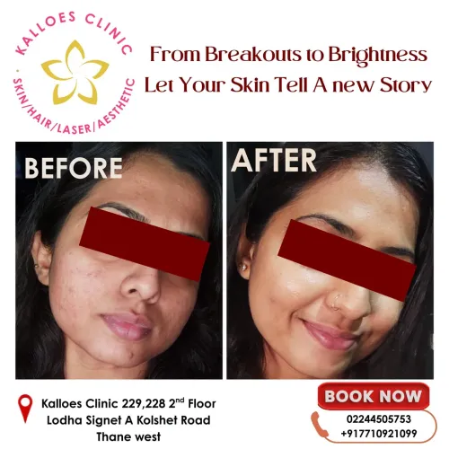 Acne / Acar Scar treatment service image