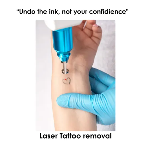 tattoo removal service image