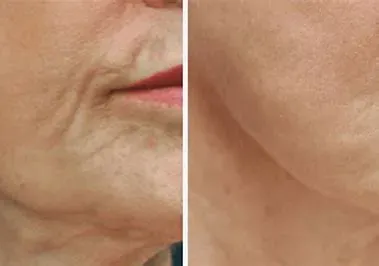 RF SKIN TIGHTENING service image