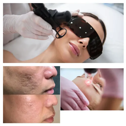 CO2 LASER RESUFACING service image