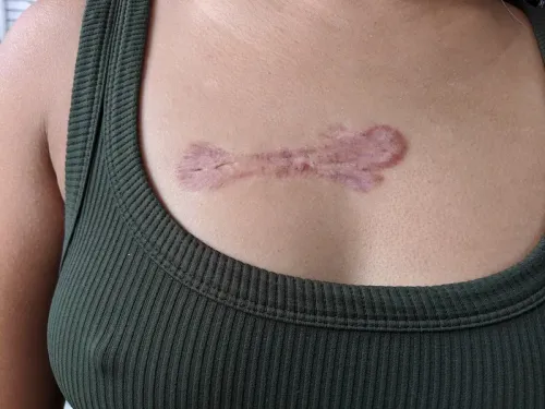 KELOID TREATMENT/ HYPERTROPIC SCAR service image