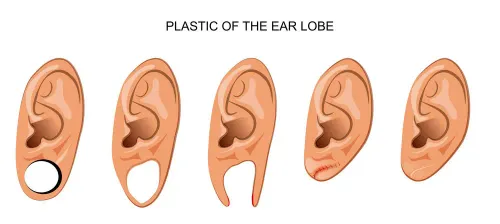 EAR LOBE REPAIR service image