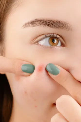 Acne and acne scars service image