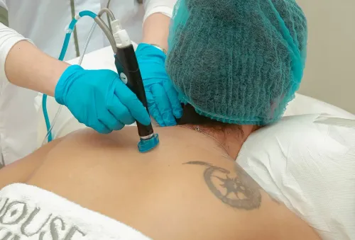 Tattoo Removal service image