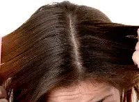 Dandruff Treatment service image