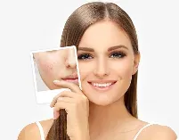 Acne and Acne Scars service image