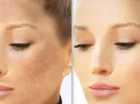 Uneven Skin tone Treatment in Coimbatore service image