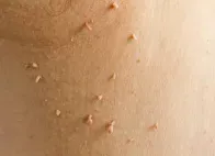 Skin Tag Removal Treatment in Coimbatore service image