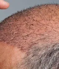 Hair Transplantation Clinic in Coimbatore  service image