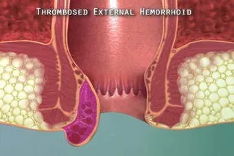 LASER SURGERY FOR PILES  service image