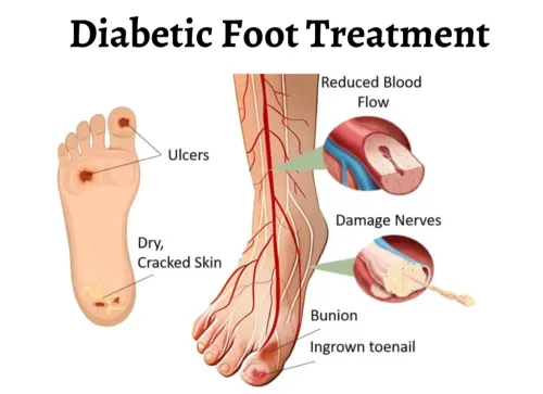 Best Diabetic Foot Surgery Specialist in Wakad, PCMC, Pune  service image