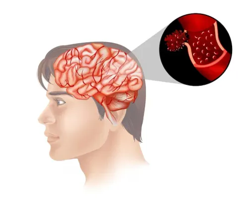 Brain Infections (Brain TB) service image