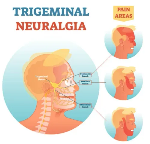 Trigeminal Neuralgia service image
