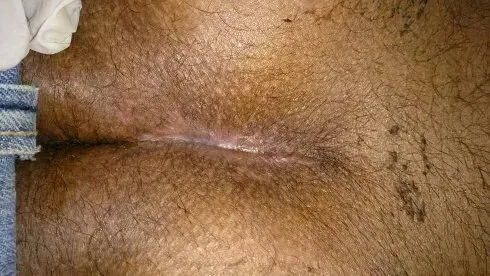 LASER Treatment Pilonidal Sinus  service image