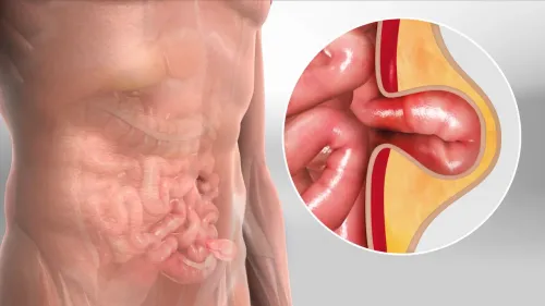 Best Hernia Treatment Specialist in Wakad, PCMC  service image