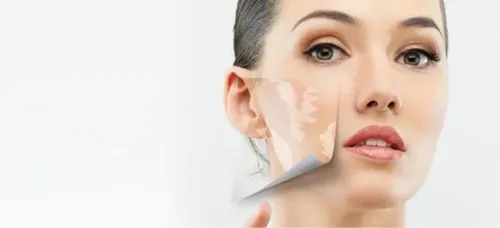 VITILIGO SURGERY service image