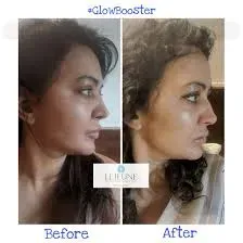 Skin Booster service image