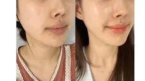 Exosome Facial service image
