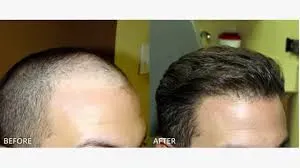  FUE HAIR TRANSPLANTATION  service image