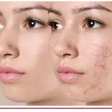 Anti Acne Treatment service image
