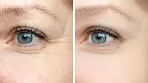 Under Eye Lifting Laser Treatment service image